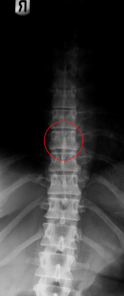 what-causes-spinal-lesions-wehelpcheapessaydownload-web-fc2